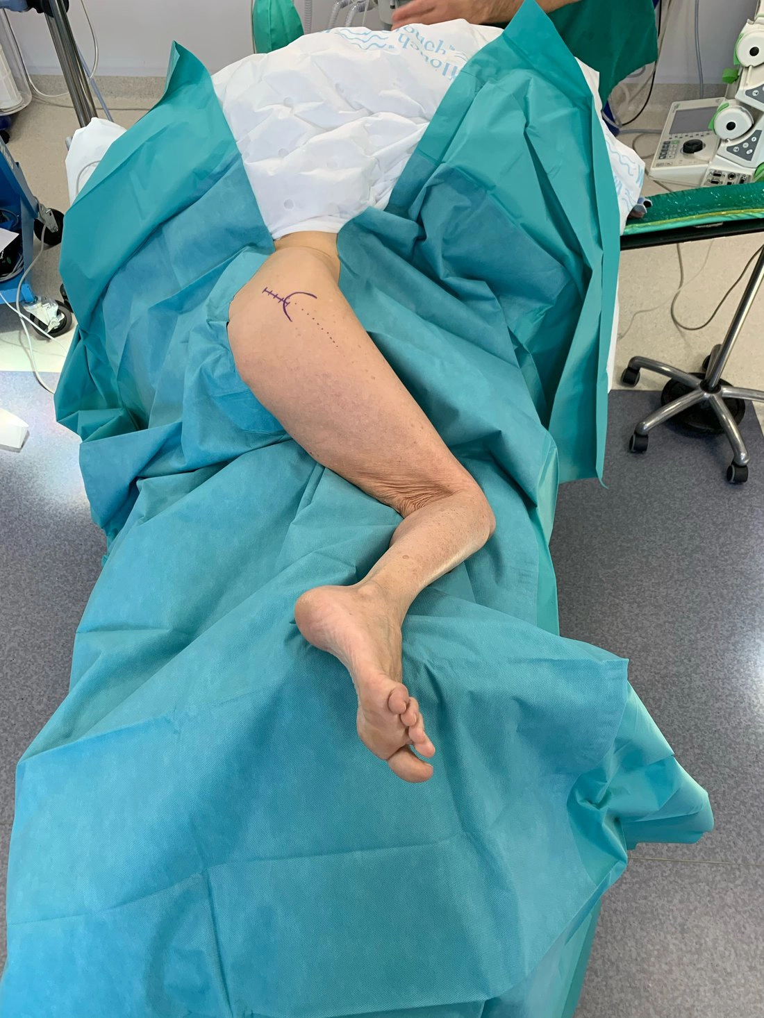 Installation du patient au bloc opératoire pour une voie SuperPath, en décubitus latéral avec jambe fléchie