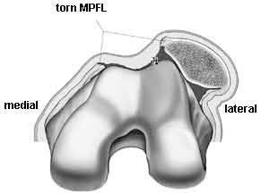 Schéma d'une rupture du ligament fémoro-patellaire médial (MPFL) après luxation externe de la rotule.